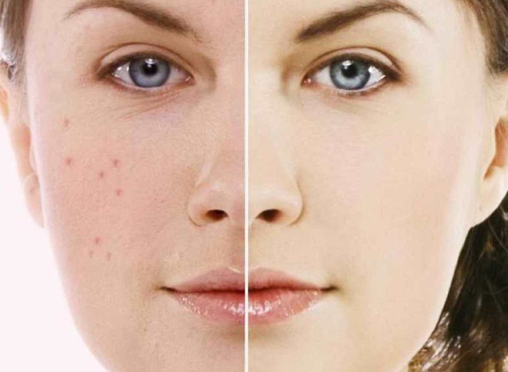 Acne and Its Prevention and Treatment