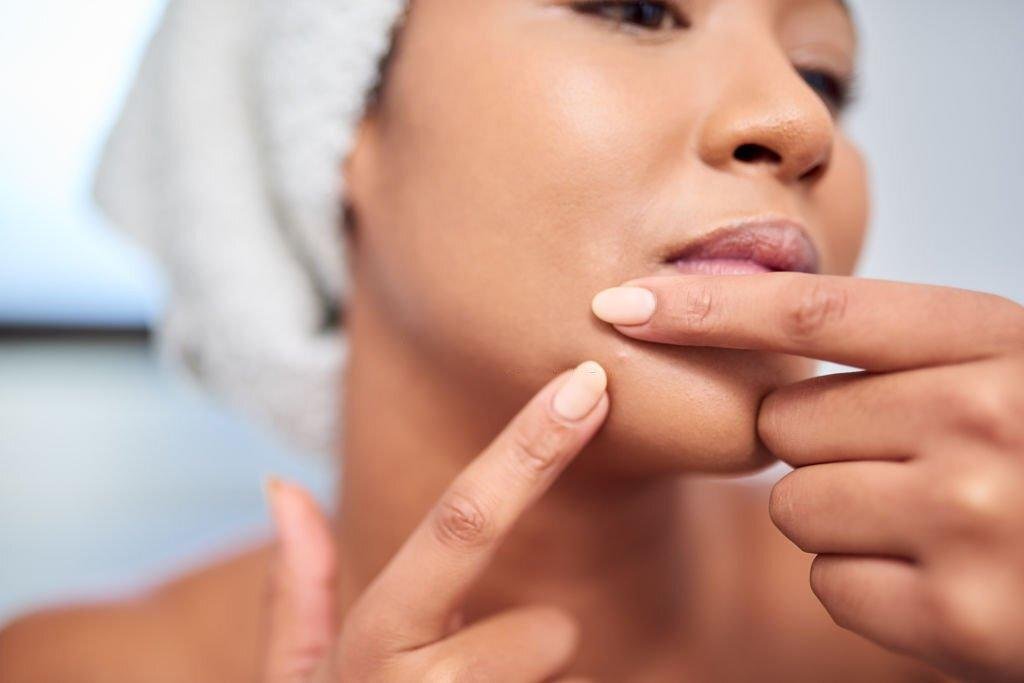 The Role of Acupuncture in Treating Chin Acne According to Chinese Medicine